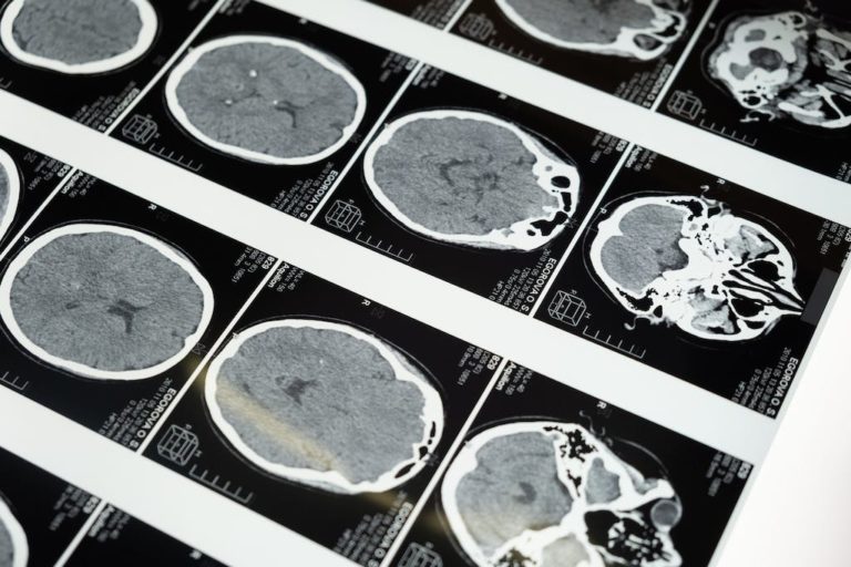 Lab Conducts a Collaborative Research Project with TVGH to Predict Progression-free Survival in Brain Tumor