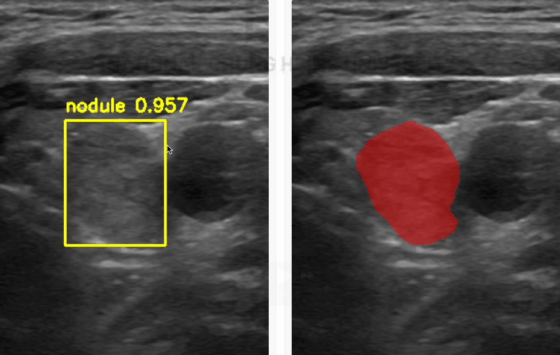 Automatic Thyroid Nodule Detection, Segmentation, and Classification in Ultrasound Images Based on Deep Learning